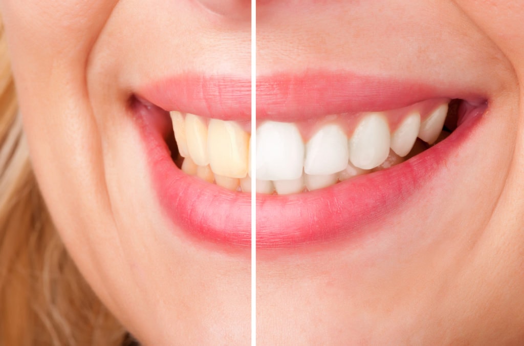 Woman's smile before and after whitening